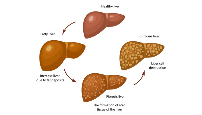 Liver cirrhosis